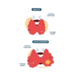 Hypothyroidism <br> (Low Thyroid Function)