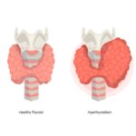 Hyperthyroidism <br> (Overactive Thyroid)