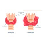 Goitre <br> (Thyroid Enlargement)